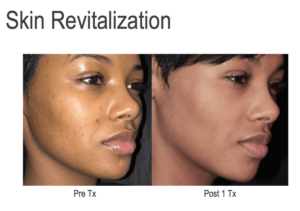 Skin Revitalization Before After Jacksonville FL