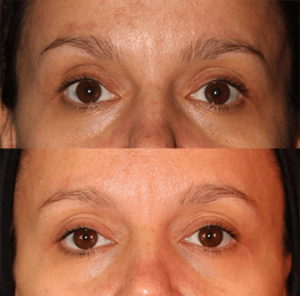 ultherapy before after jacksonville