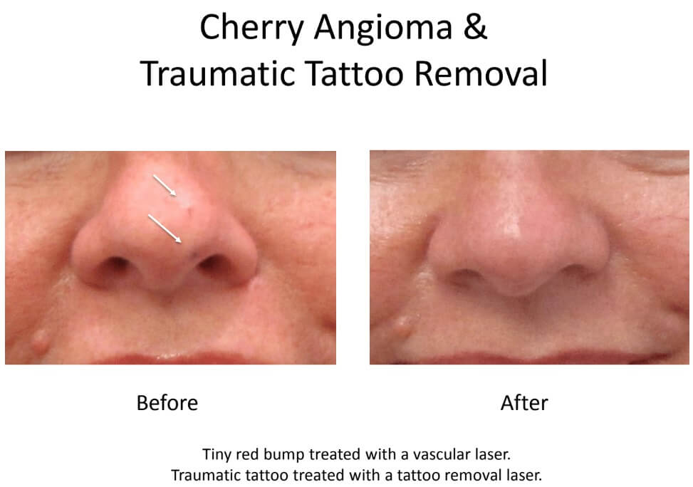 cherry angioma and traumatic laser tattoo removal cost on nose (1)