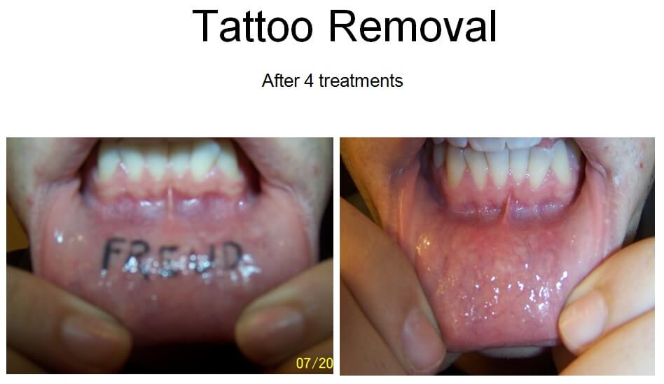 Laser Tatoo Removal Cost - freud inside lip