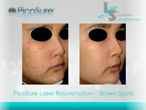 Brown Spots Removal Jacksonville FL