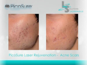 Acne Scars Before After Jacksonville FL