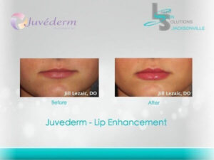 Juvederm Before After Jacksonville FL