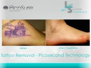 Tattoo Removal Before After Jacksonville FL