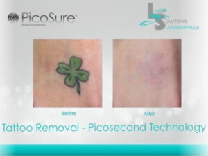 Tattoo Removal Before After Jacksonville FL