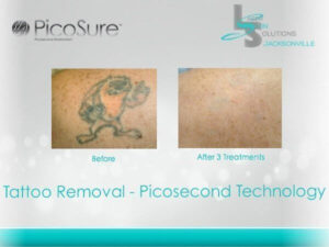 Tattoo Removal Before After Jacksonville FL