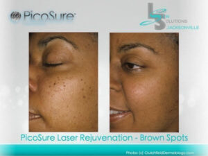 Brown Spots Dark Skin Jacksonville FL