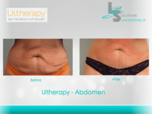 Ultherapy Before After Jacksonville FL