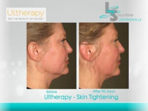 Ultherapy Skin Tightening Before After Jacksonville FL