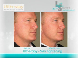 Men Ultherapy Before After Jacksonville FL