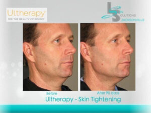 Male Ultherapy Before After Jacksonville FL