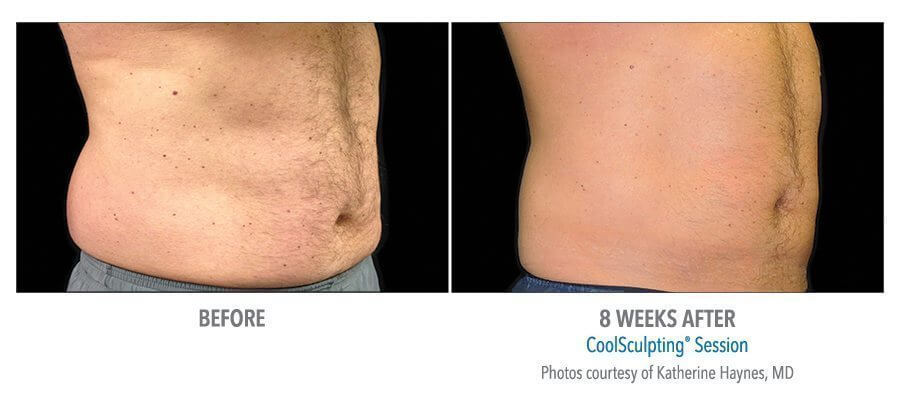 male coolsculpting before after jacksonville