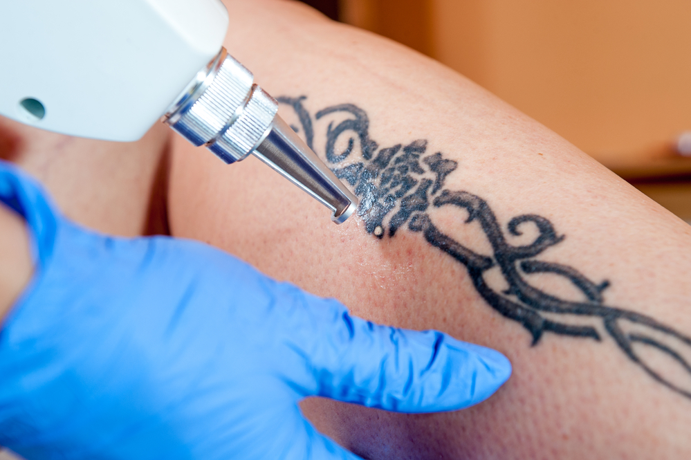 How Long Does the Tattoo Removal Process Take? - Jacksonville FL - Laser Skin Solutions Jacksonville