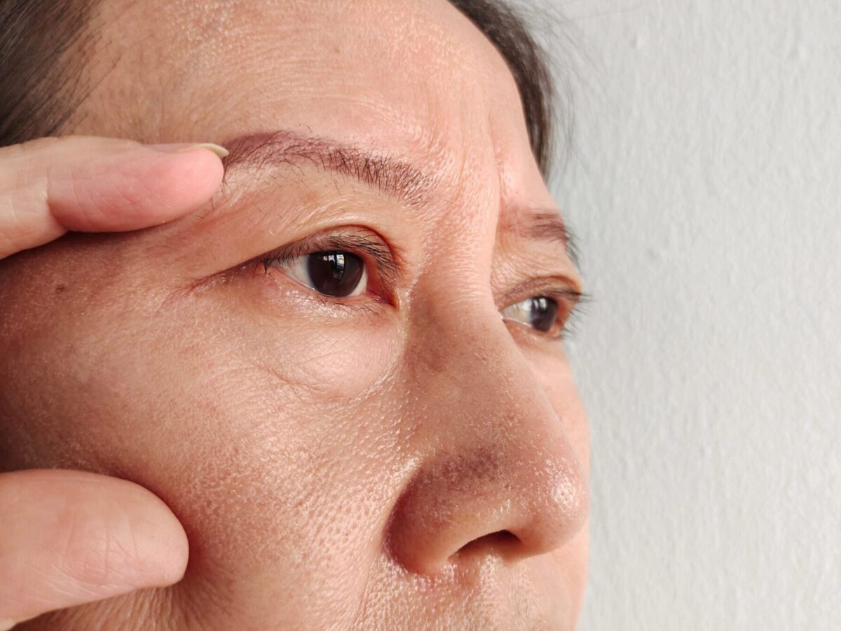 Wrinkle Removal with Laser Genesis Laser Skin Solutions