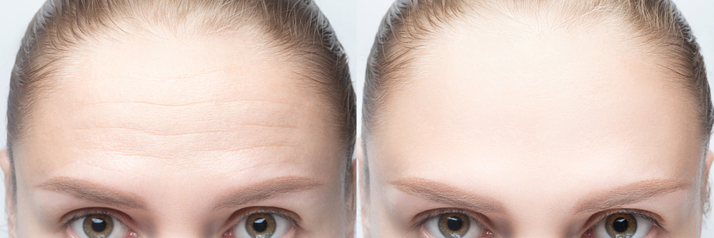 Forehead Wrinkles: Causes and Popular Treatments | Laser Skin Solutions Jacksonville