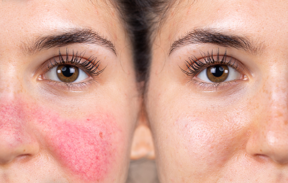 Rosacea: Understanding the Causes & Effects | Laser Skin Solutions Jacksonville