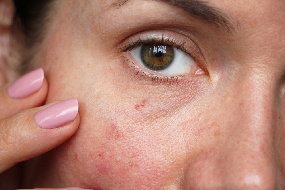 Facial Spider Veins: Unveiling Triggers & Effective Solutions | Laser Skin Solutions