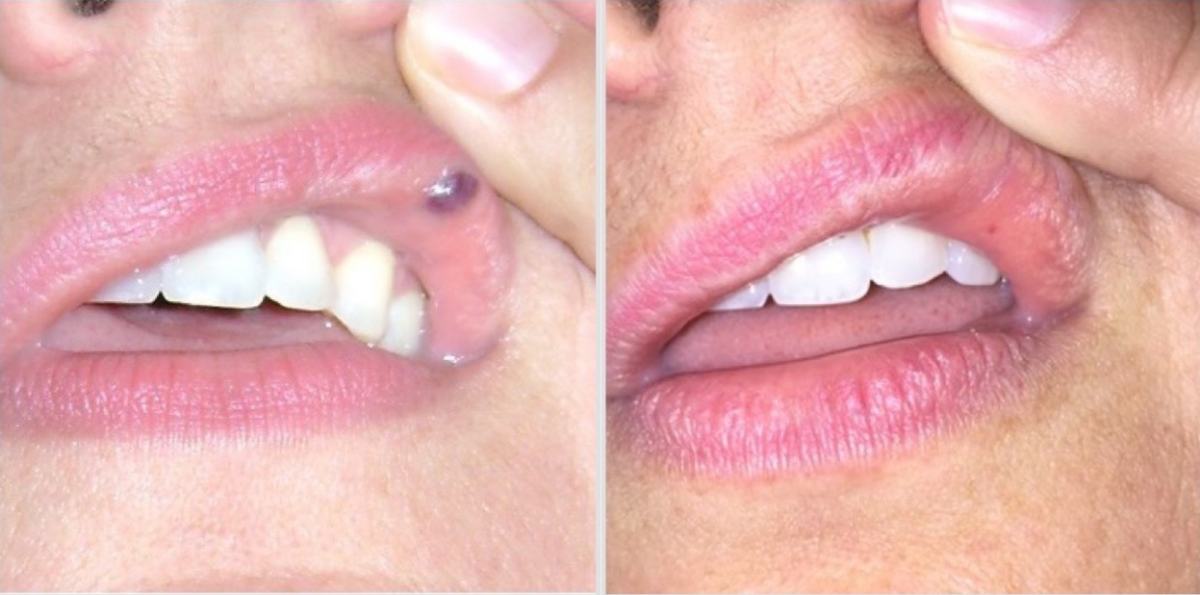 Excel V Laser Before and After | Pigmented Lesion Removal Jacksonville